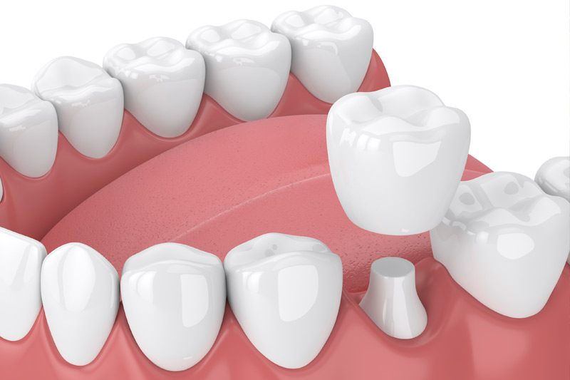 Dental Crowns in Worth