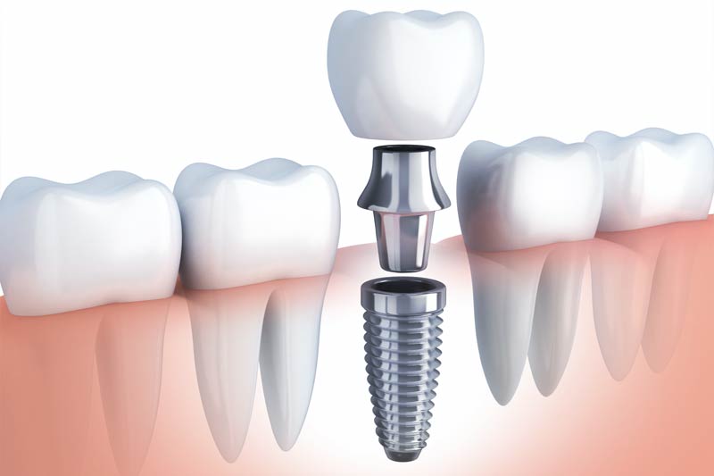 Implants Dentist in Worth