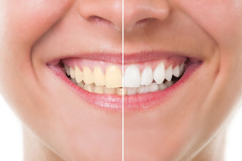 Teeth Whitening in Worth