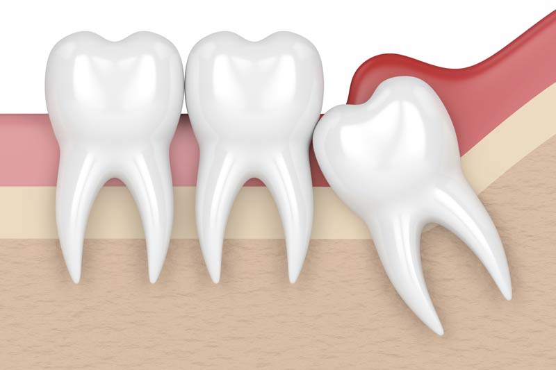 Wisdom Tooth Removal in Worth